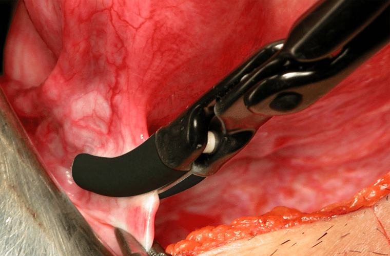 Electrocautery Machine - Vessel Sealer